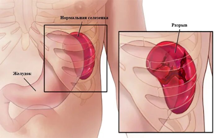 Слабости селезенки. Разрыв селезенки травмы.
