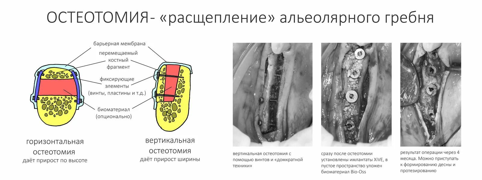 Убыль костной ткани альвеолярного отростка. Расширение костной ткани. Расширение костной ткани. Наращивание костной ткани челюсти. Костная пластика альвеолярного отростка верхней челюсти.