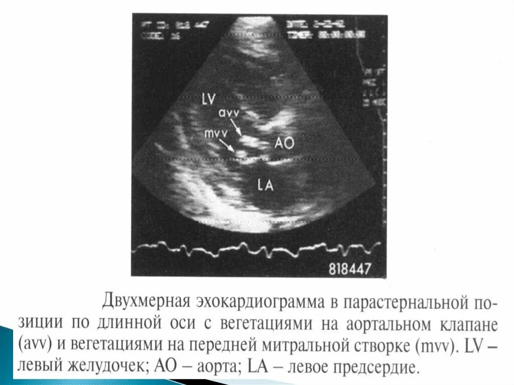 Эндокардит митрального клапана УЗИ. Инфекционный эндокардит ЭХОКГ. ЭХОКГ при инфекционном эндокардите. Вегетации на клапанах сердца эхокардиография. Вегетация сердца