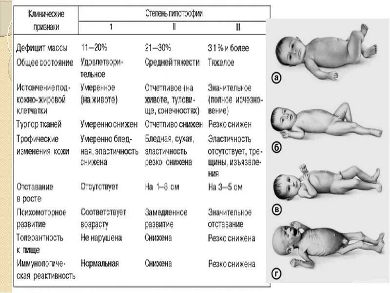 Степени у новорожденных. Клинические симптомы гипотрофии. гипотрофия 1 степени у новорожденного. гипотрофия 1 степени у детей диагностика. гипотрофия у детей раннего возраста степени.