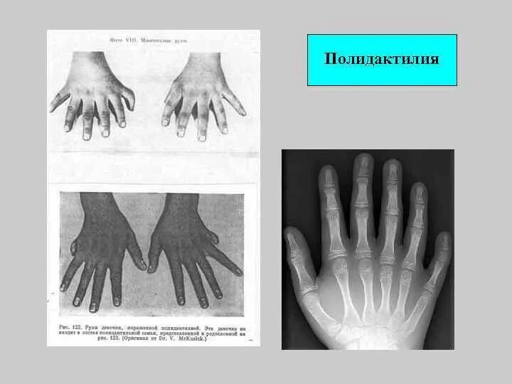 Полидактилия пальцев кисти. Полидактилия проявления заболевание.