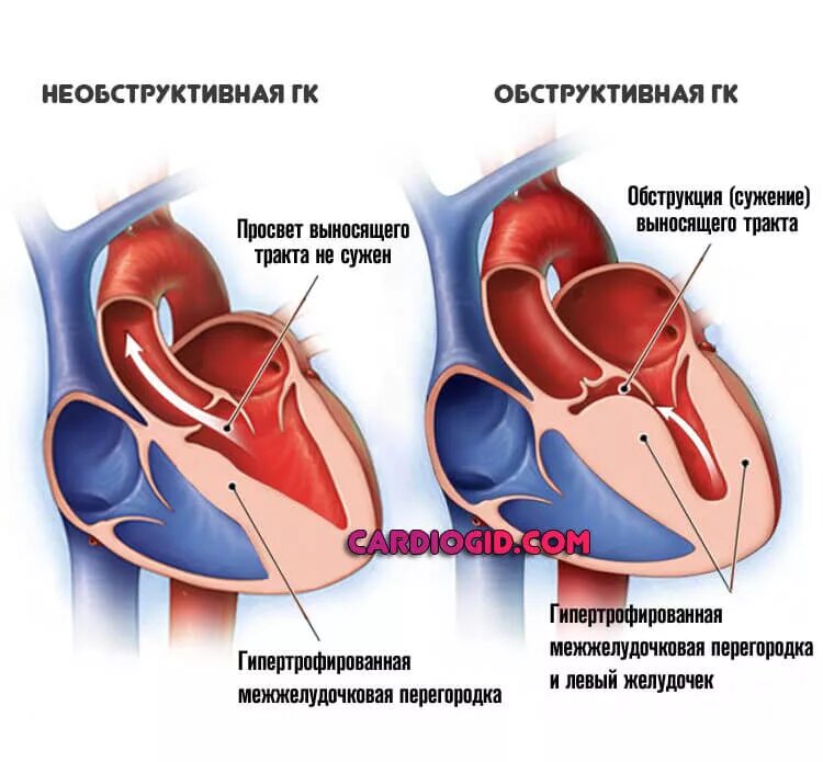 ГКМП обструктивная форма. Обструктивная форма гипертрофической кардиомиопатии. Обструктивная гипертрофия кардиомиопатия. Кардиомиопатия левого желудочка. Миокард правого желудочка сердца