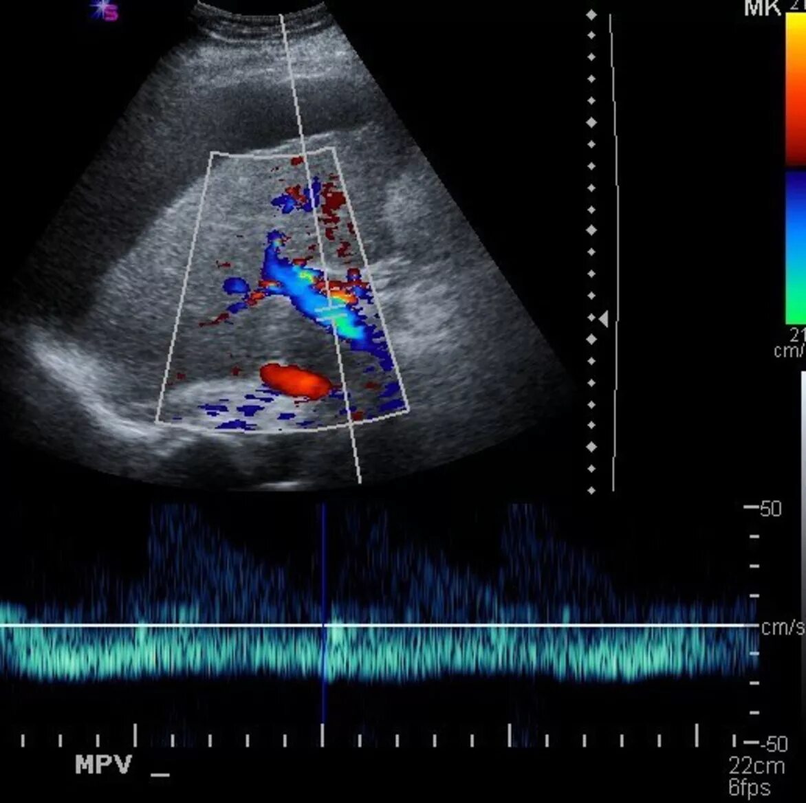 Доплер почек. Импульсная спектральная допплерография. Импульсная допплерография воротной вены. УЗИ допплерография воротной вены. УЗДГ сосудов воротной вены.