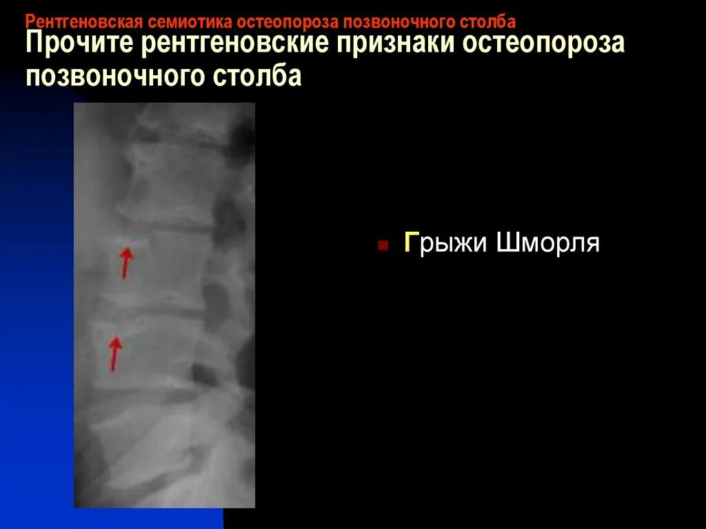 Внутричерепное давление рентген. Остеопороз у подростков. Размеры турецкого седла кт. Рентгенологические признаки внутричерепной гипертензии. Внутричерепная гипертензия на рентгене черепа.