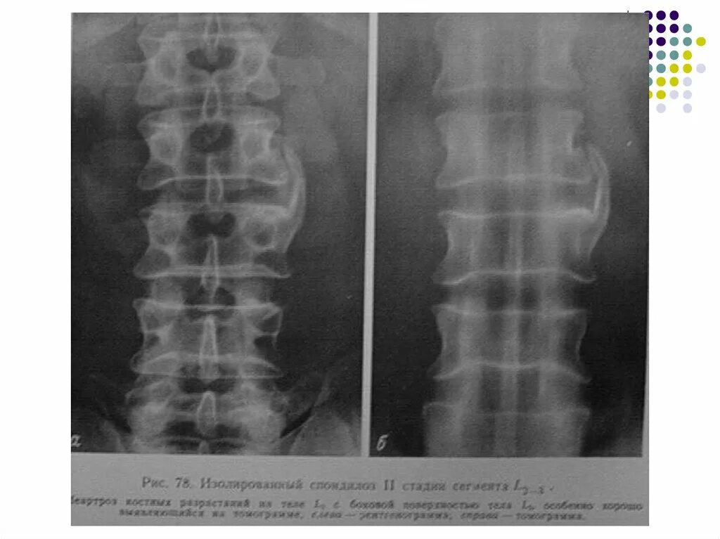 Дегенеративно дистрофические изменения пояснично крестцового. Дегенеративно-дистрофические изменения рентген. деструктивные изменения в позвоночнике что это. рентгенодиагностика позвоночника. дистрофические изменения позвоночника.