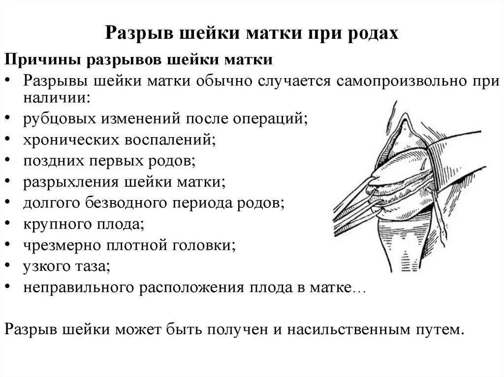 Как избежать разрывов. Шейка матки разрыв 1 степени. Акушерский разрыв шейки матки 1 степени. Разрыв шейки матки в родах. Разрыв шейки матки первой степени в родах.