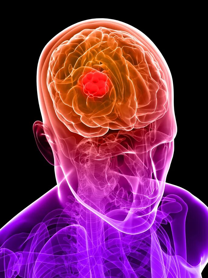 Brain 28. Фотодинамическая терапия опухоли кожи. Злокачественная опухоль головного мозга.