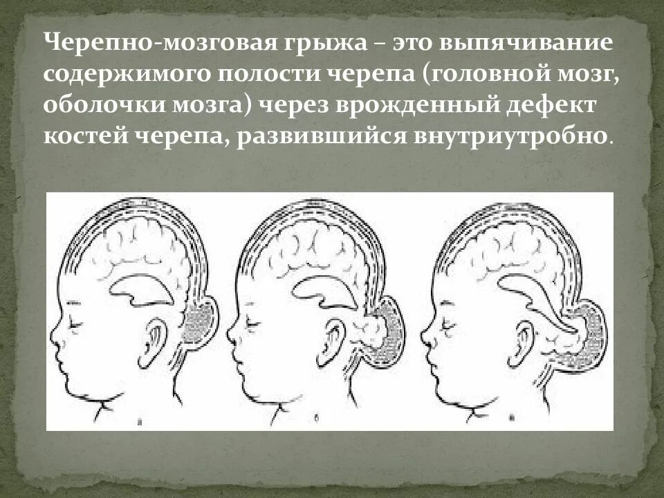 Аномалии развития нерва. Аномалии развития головного мозга у детей. Черепномозловые грыжи. Черепно мозговые грыжи у детей.