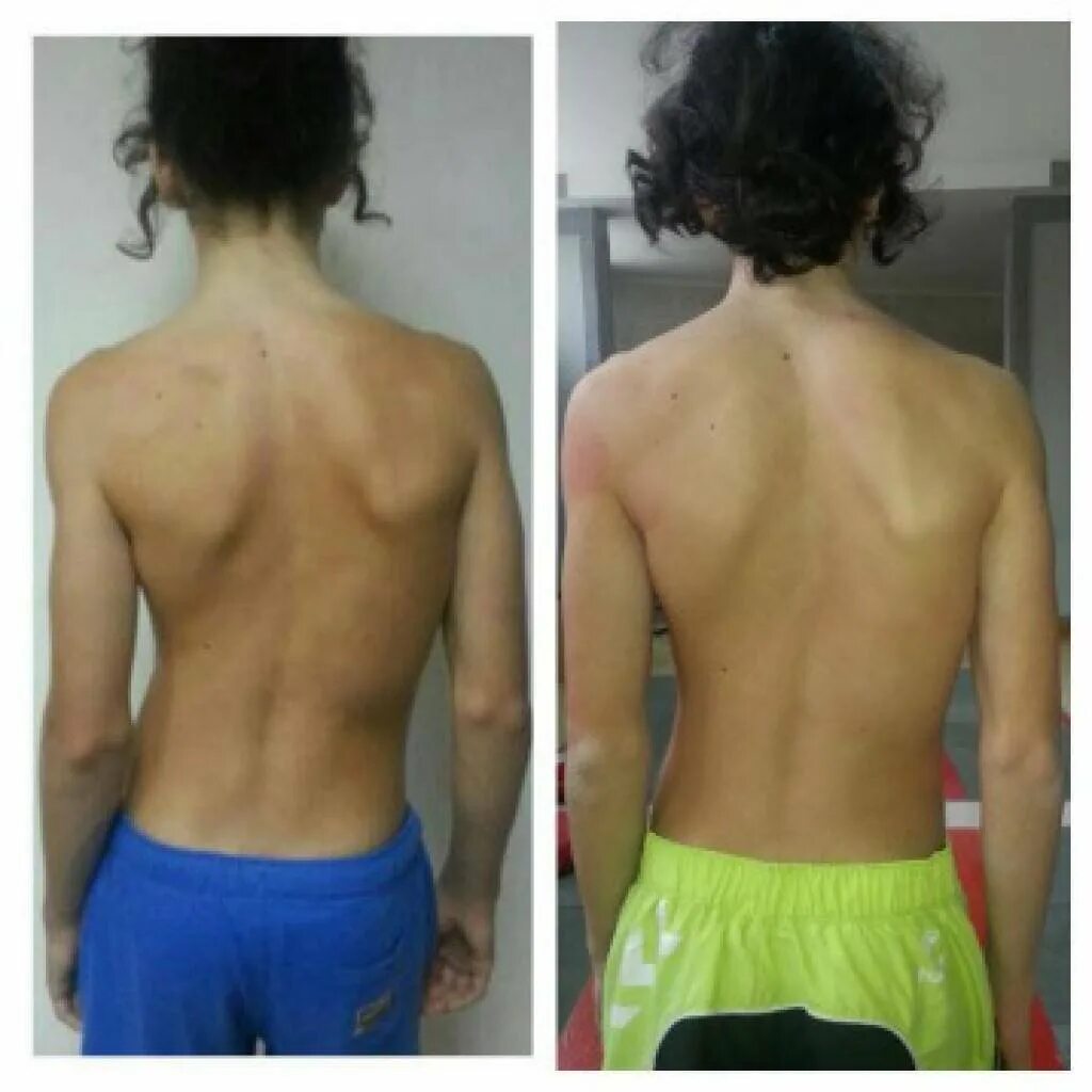 Упражнения гимнастика катарины шрот. Методика катарины шрот. Катарина шрот дыхательная гимнастика при сколиозе. Сколиоз шрот терапия. Упражнения гимнастика катарины шрот.