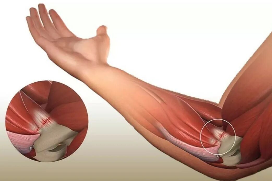 Почему болят локтевые сгибы. Латеральный эпикондилит локтевого. Эпикандилитлоктекого сустава. Медиальный эпикондилит локтевого. Латеральный эпикондилит сухожилие.
