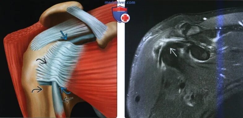 Повреждение сухожилия подлопаточной мышцы. Повреждение ротаторная манжета. Ротаторная манжета мрт. Повреждение ротаторной манжеты мрт. Ротаторная манжета плечевого сустава мрт.