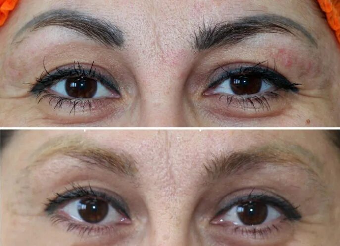 Удаление татуажа бровей ремувером - Todeska Brows - Салон красоты