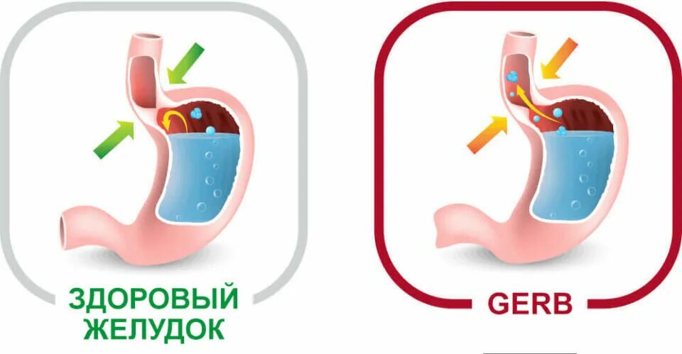 Удаление воздуха из желудка. Изжога иконка. Жиғилдон қайнаши. На фоне качания может появиться ГЭРБ.