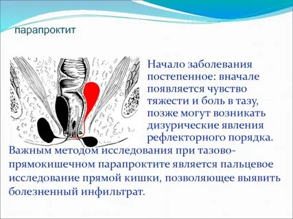 Можно при парапроктите