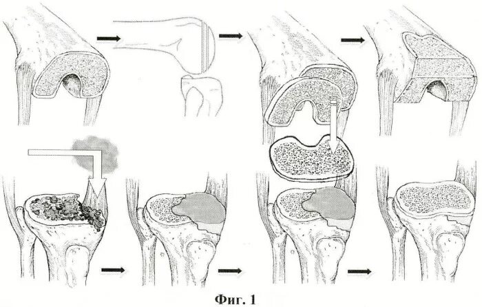 Дисплазия блока бедренной кости классификация. Эндопротез бедренной кости коленного сустава. Эндопротезирование мыщелка большеберцовой кости. Асептический некроз внутреннего мыщелка бедренной кости. Некроз мыщелка бедренной