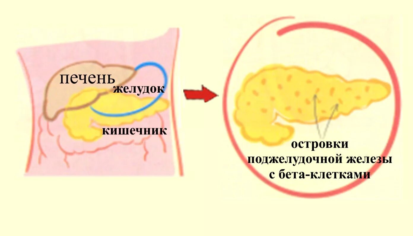 Сахарный диабет поджелудочная железа с бета клетками. Поджелудочная железа бета клетки инсулин. Разрушение бета клеток поджелудочной железы при сахарном диабете. Островки Лангерганса поджелудочной железы. Пересадка поджелудочной при диабете