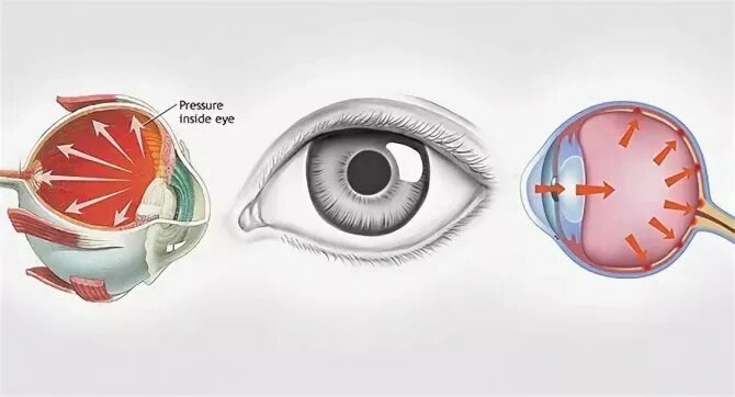 Внутриглазное давление глаза. Повышенное внутриглазное давление.