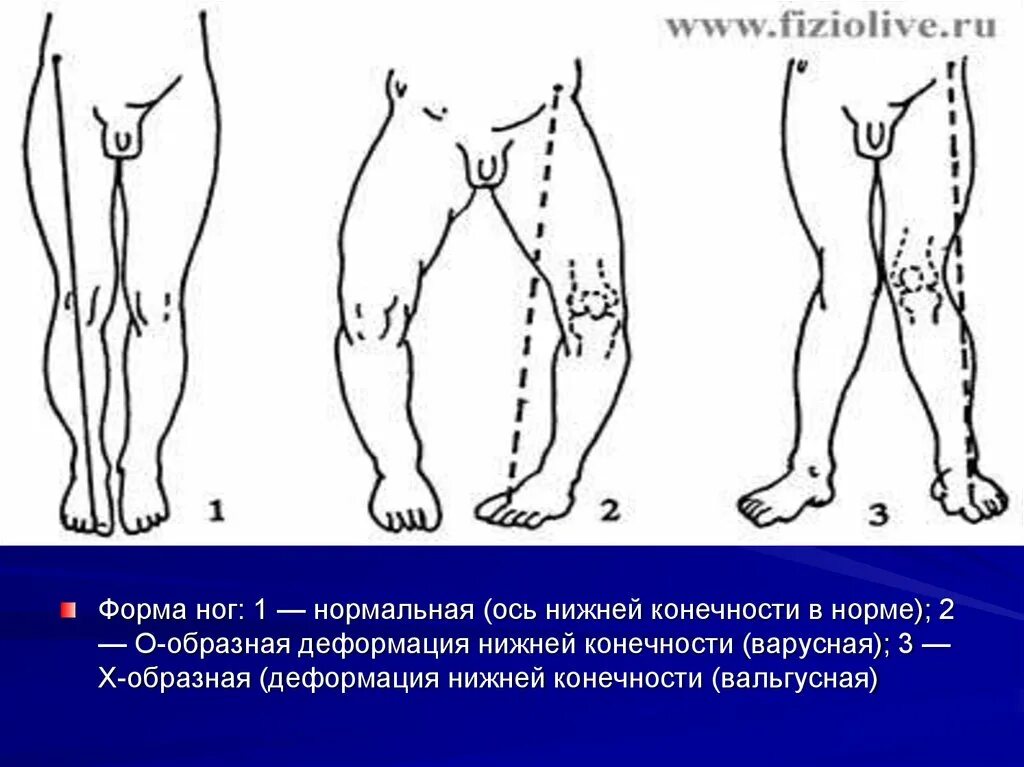 Развитие нижней конечности. Нормальная ось нижней конечности. Ось нижней конечности в норме. Ось конечности нижней конечности. Осевые деформации конечностей.