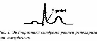 Синдром ранней желудочков