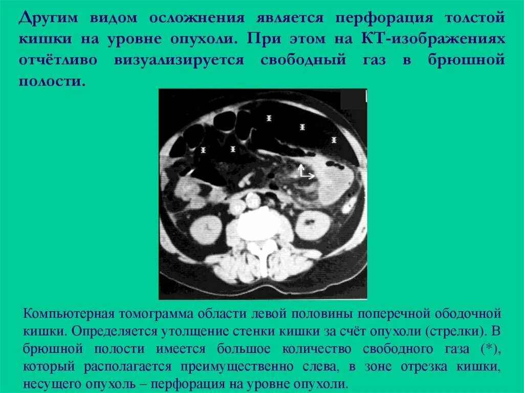 Исследование прямой и сигмовидной кишки. Опухоль сигмовидной кишки на кт. Перфорация ободочной кишки на кт. Опухоль ободочной кишки на кт.