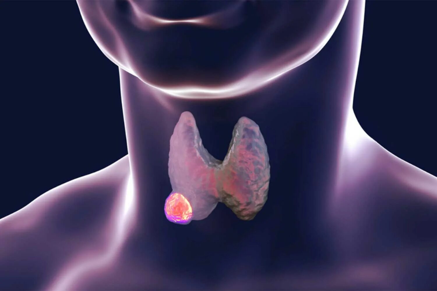 Злокачественное Перерождение щитовидной железы. Опухоль в щитовидной железе.