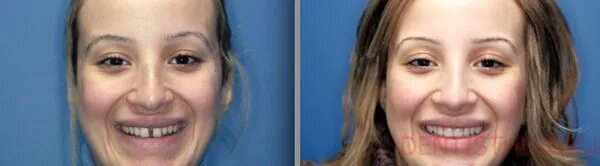 Диастема темникова. Как убрать щербинку между передними. Как убрать щербинку между передними. Елена темникова щербинка. Как убрать щербинку между передними.