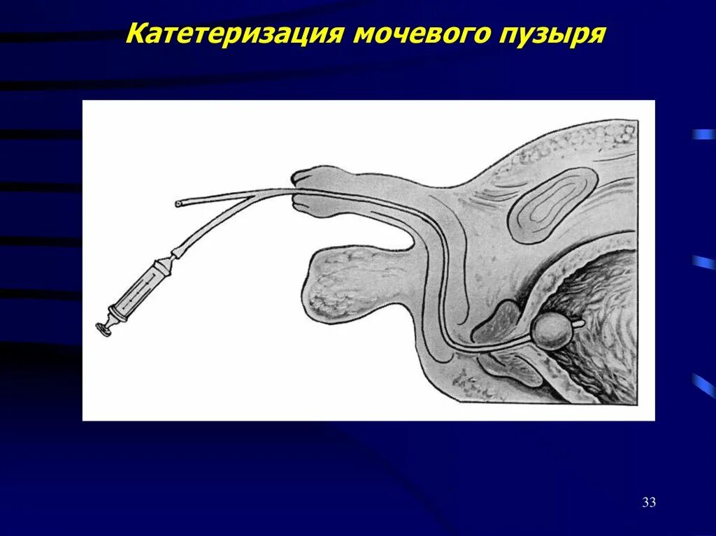 Катетер вводится