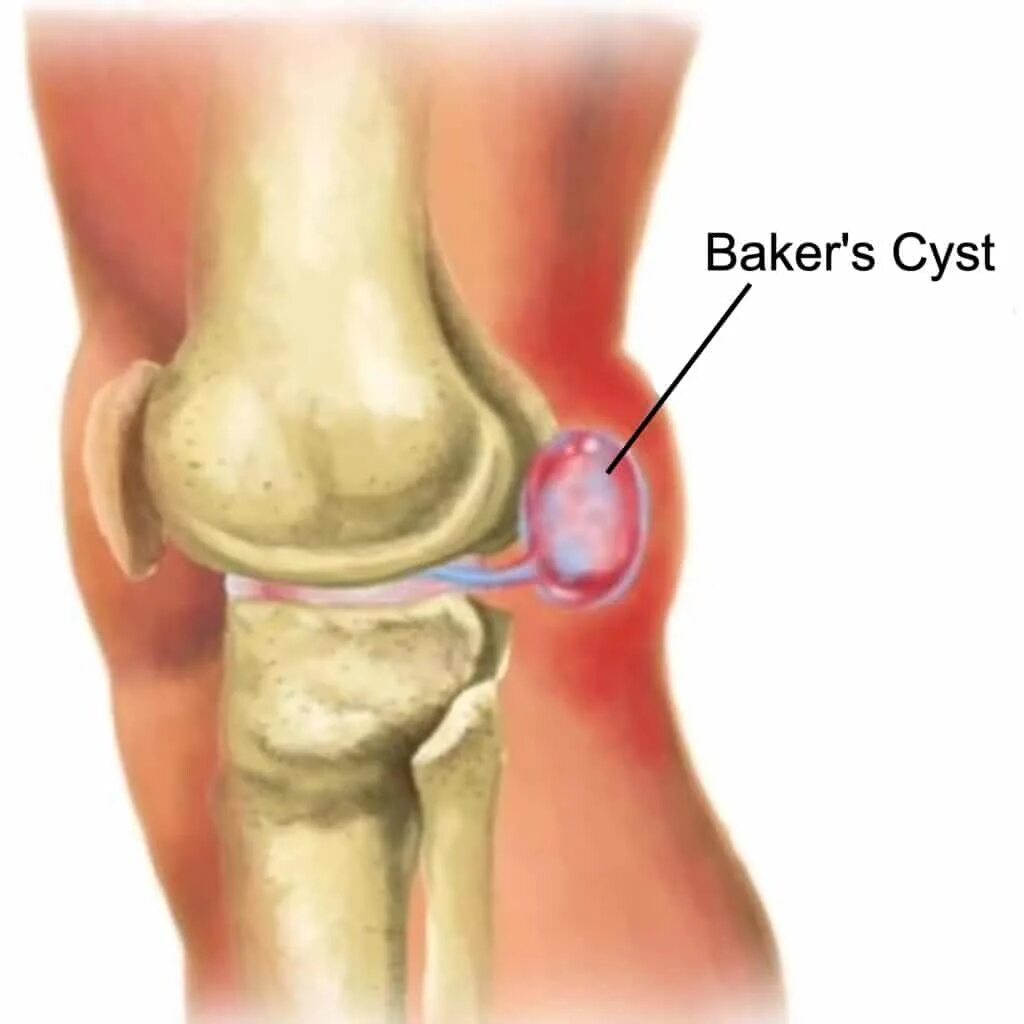 Киста Бейкера коленного сустава. Грыжа Беккера Бейкера коленного сустава. Кисты подколенной ямки киста Бейкера. Киста Беккера в коленном.
