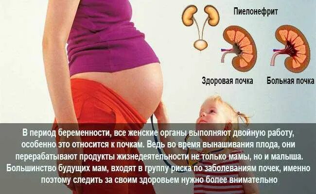 Пиелонефрит 2 триместр. Почки при беременности. Пиелонефрит и беременность. Пиелонефрит почки у беременных.