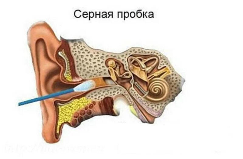 Серы ты не шути. Строение уха ушная пробка. Серная пробка на барабанной перепонке. Внутреннее ухо серная пробка. Ушная сера в барабанной перепонке.