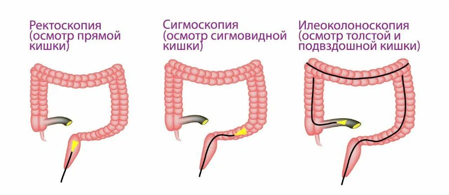 Подготовка к ректоскопии. Строение кишечника колоноскопия. Язвенный колит сигмовидной и прямой кишки. Исследование прямой и сигмовидной кишки. Исследование прямой кишки ректоскопия.