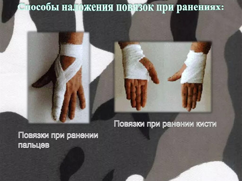 Теплоизолирующая повязка при отморожении. Термоизолирующая повязка. теплоизолирующая повязка наложение. термоизолирующая повязка на кисть. наложение термоизолирующей повязки на кисть.