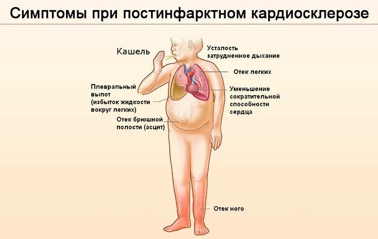 Признаки постинфарктного кардиосклероза. Кардиосклероз клинические проявления. постинфарктный кардиосклероз терапия. синдромы при ибс постинфарктный кардиосклероз. клинические проявления постинфарктного кардиосклероза.
