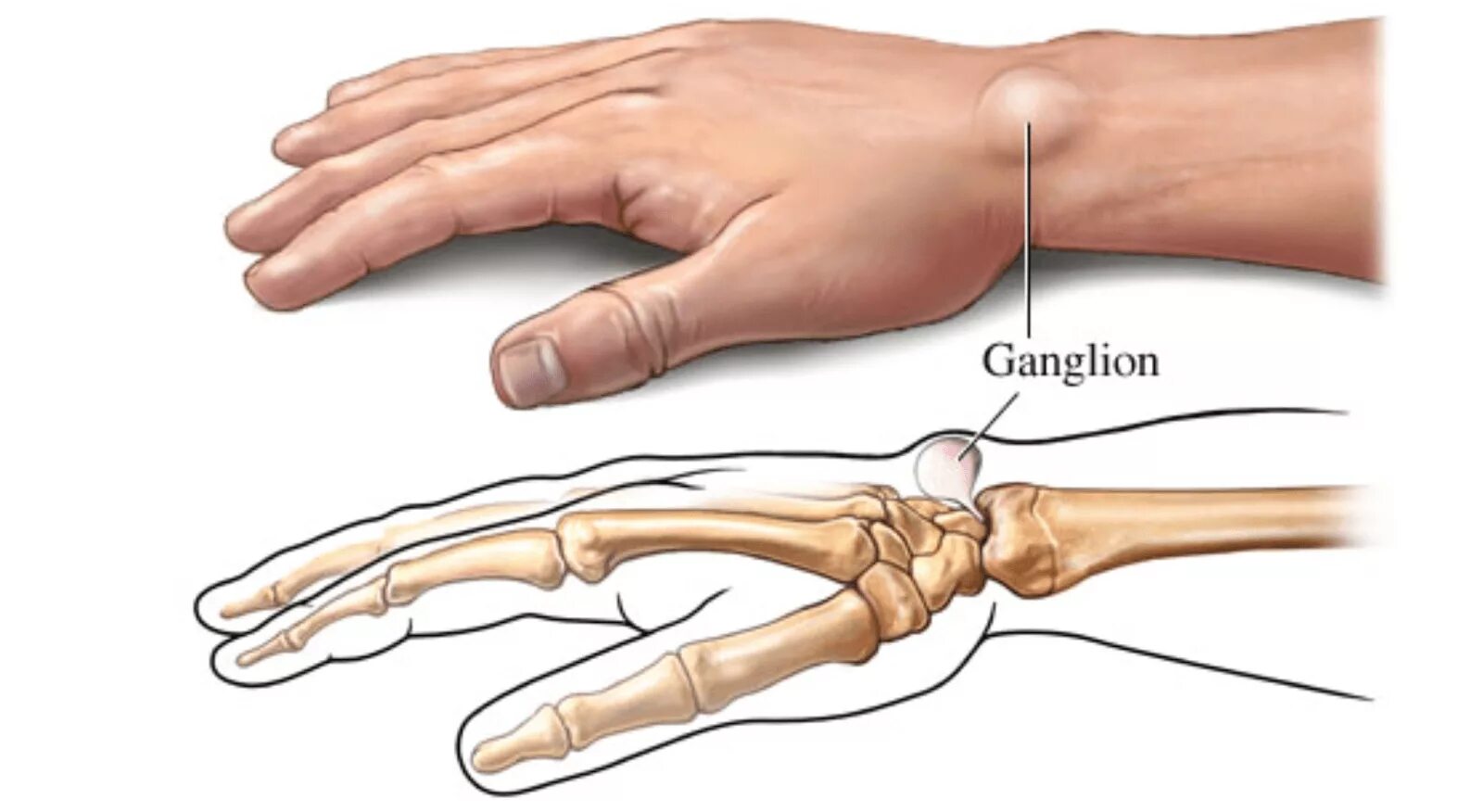 Почему болит кость пальца. Гигрома сухожильный ганглий. Гигрома лучезапястного сустава. Ганглион лучезапястного сустава. Стенозирующий лигаментит.