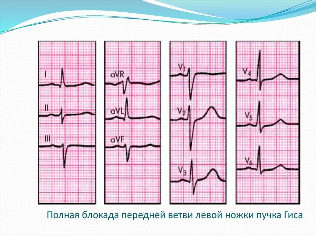 Неполная блокада передней. ЭКГ при блокаде передней ветви левой ножки пучка Гиса (ЛНПГ). Блокада ветвей левой ножки пучка Гиса на ЭКГ. Блокада передней ветви левой ножки пучка Гиса на ЭКГ. Блокада передне-верхней ветви ЛНПГ.