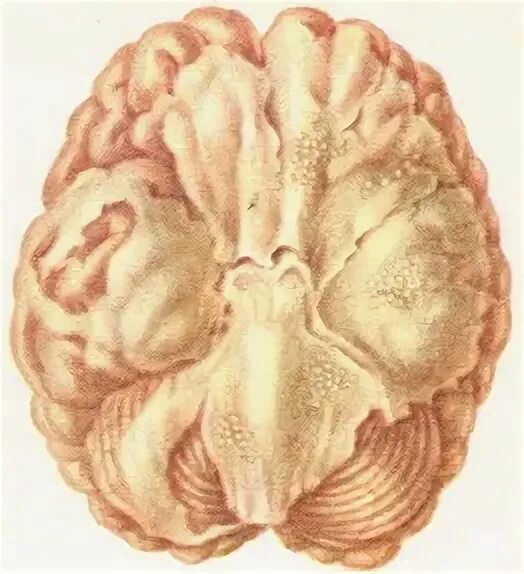 Туберкулез головного. Базилярный туберкулезный менингит. Туберкулёз центральной нервной системы и мозговых оболочек. Туберкулезный менингоэнцефалит. Патанатомия туберкулез мозга.