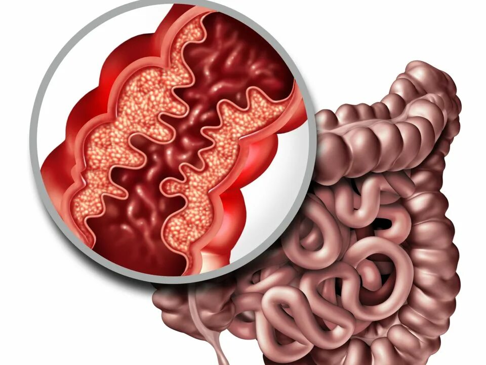 Проблема кишечника кровь. Болезнь крона тонкой кишки. Болезнь крона кишечник. Болезнь крона тонкого кишечника.