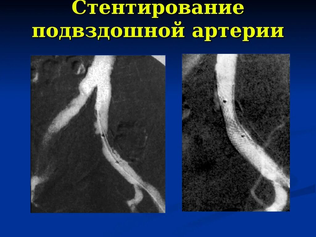 Аневризма подвздошной артерии кт. Мешотчатая аневризма наружной подвздошной артерии кт. Расслаивающая аневризма аорты рентген. Расслаивающаяся аневризма аорты кт.