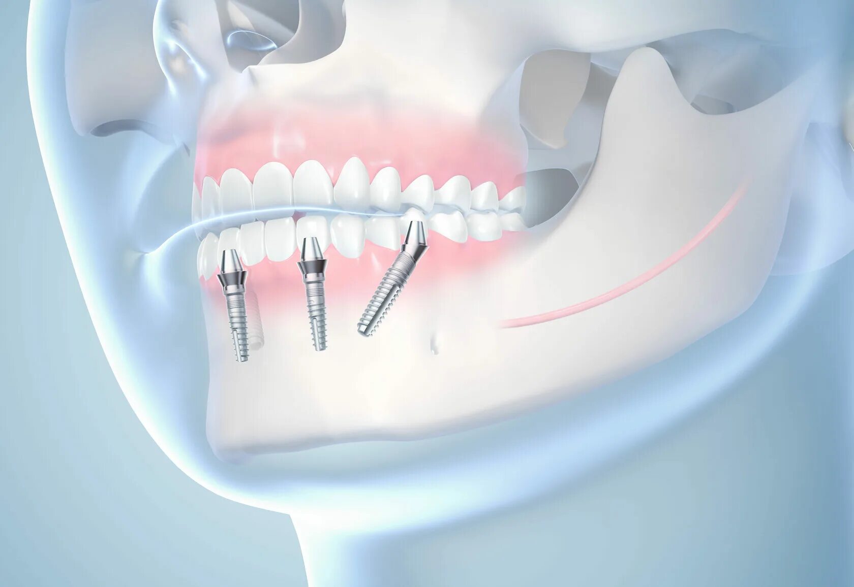 Имплантанты all on 4 зубные. All 4 протезирование челюсти. 3 зуба установить