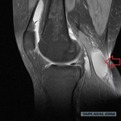 Мультилокулярная киста Бейкера. Киста Бейкера коленного сустава анатомия.