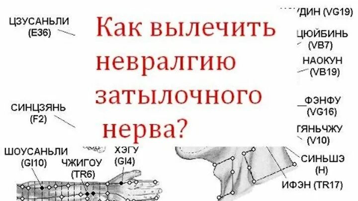 Схема лечения невралгии затылочного нерва медикаментами. Невралгич затылочногонерва. Место выхода затылочного нерва. Точки выхода затылочного нерва. Невропатия затылочного