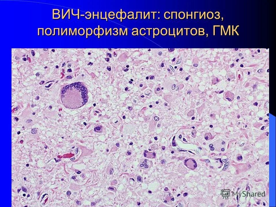 Многоядерные клетки пирогова-лангханса. Гистология фундального отдела желудка. Происходит пролиферация гладкомышечных клеток (гмк. Простатическая железа гистология. Гмк гистология.