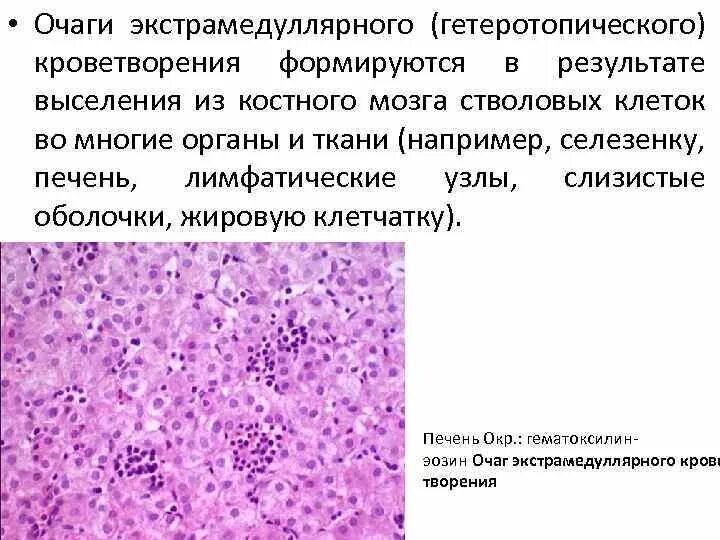 Печени и костного мозга. Экстрамедуллярные очаги кроветворения. Очаги экстрамедуллярного кроветворения в печени. Экстрамедуллярное кроветворение в печени микропрепарат. Кроветворение гемопоэз гистология.