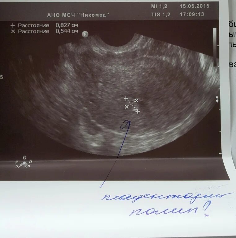 Полип эндометрия размеры. УЗИ матки полип эндометрия или беременность. Плацентарный полип на УЗИ.