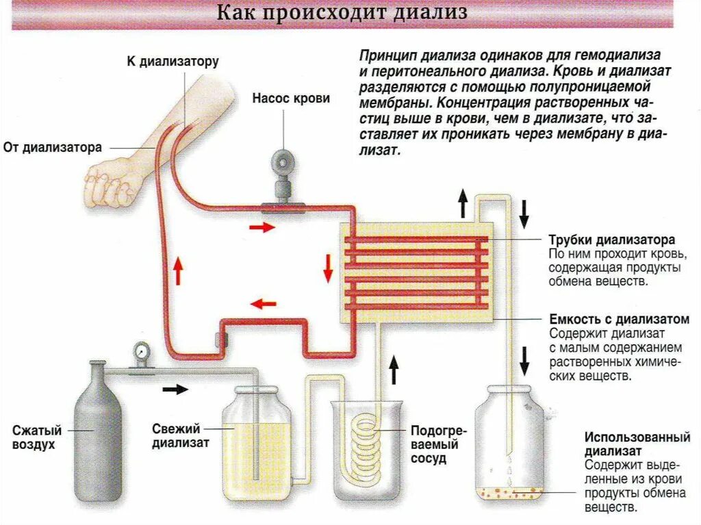 Диализ белков. Принцип действия аппарата искусственная почка диализ. Принцип работы аппарата для диализа крови. Искусственная почка для гемодиализа принцип работы. Аппарат для гемодиализа схема.