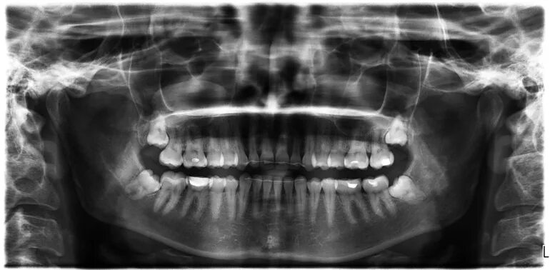 Снимок зубов видное. Ортопантомограмма кариес. Экзостоз нижней челюсти. Ортопантомограмма зубы мудрости.