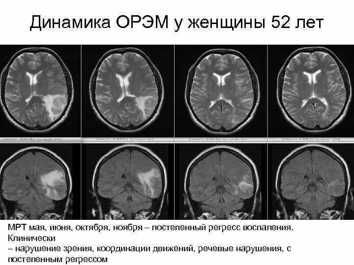 Острый рассеянный энцефаломиелит кт. Острый рассеянный энцефаломиелит мрт. Острый рассеянный энцефаломиелит (ОРЭМ). Диссеминированный энцефаломиелит мрт.