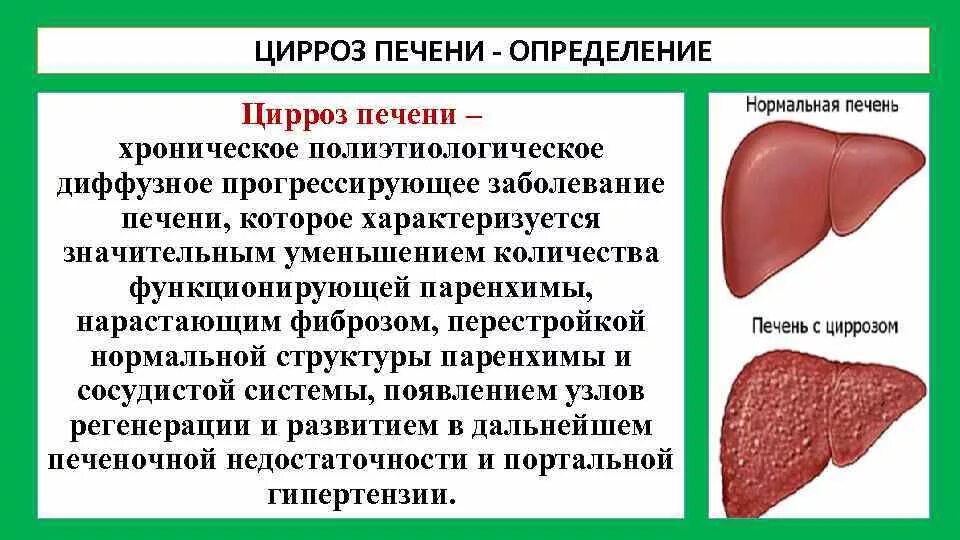 Первые симптомы печени. Наиболее характерными признаками цирроза печени являются:. циррозов печени симптоматология. структура печени при циррозе. причины заболевания цирроза печени.