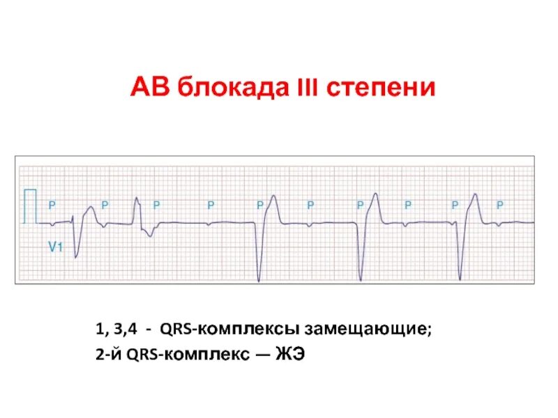 Са блокада 1 степени. Синоатриальная блокада 3 степени на ЭКГ. Синоатриальная блокада 1 степени на ЭКГ. Av блокада 3 степени. Синоатоикллгая блокада 3 степени.