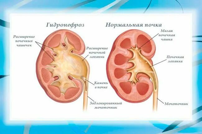 Заболевание почек гидронефроз. Расширение лоханки гидронефроз. Гидронефроз почки УЗИ. Врожденный гидронефроз (водянка почки). Гидронефроз почек ,нефростома.